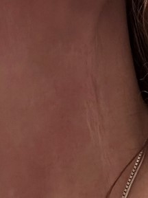 Neck scar